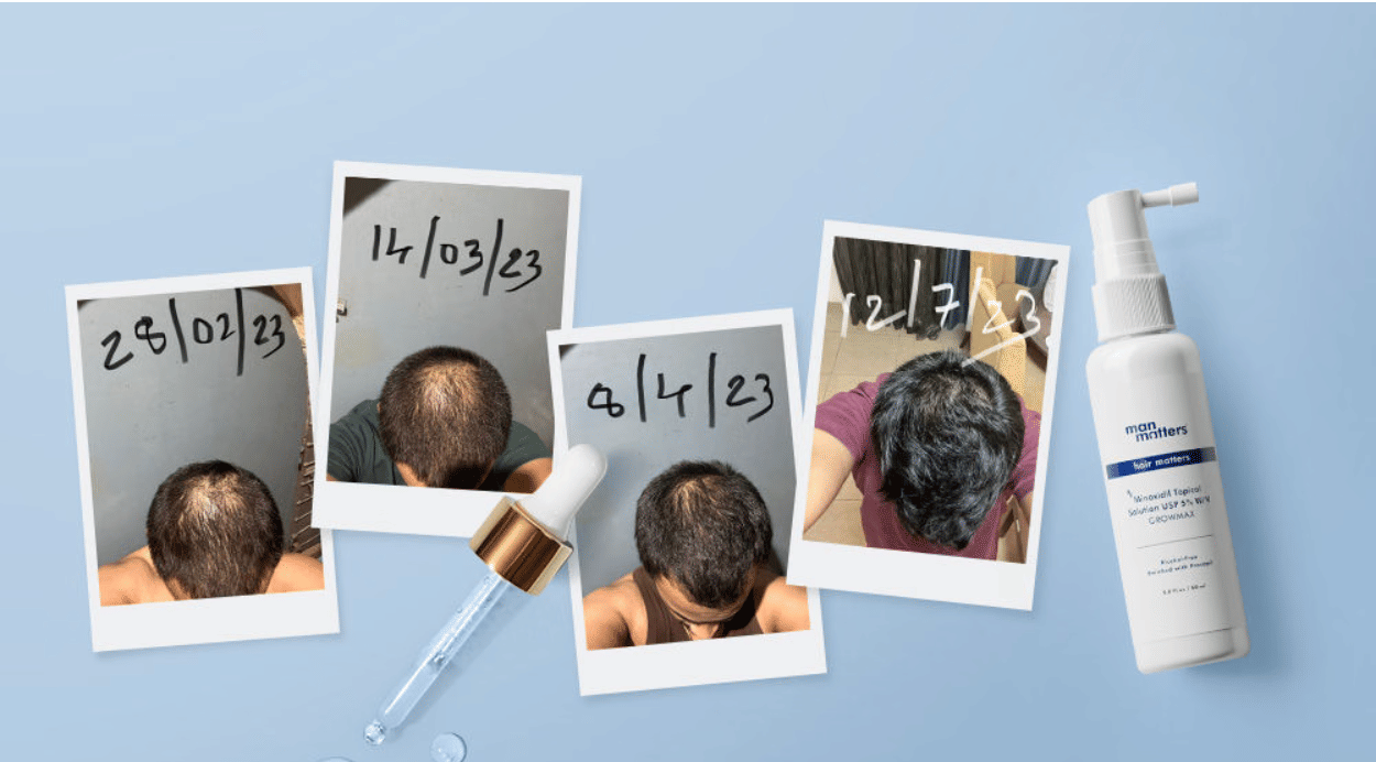 Minoxidil before and after photo showing hairline improvement after regular use