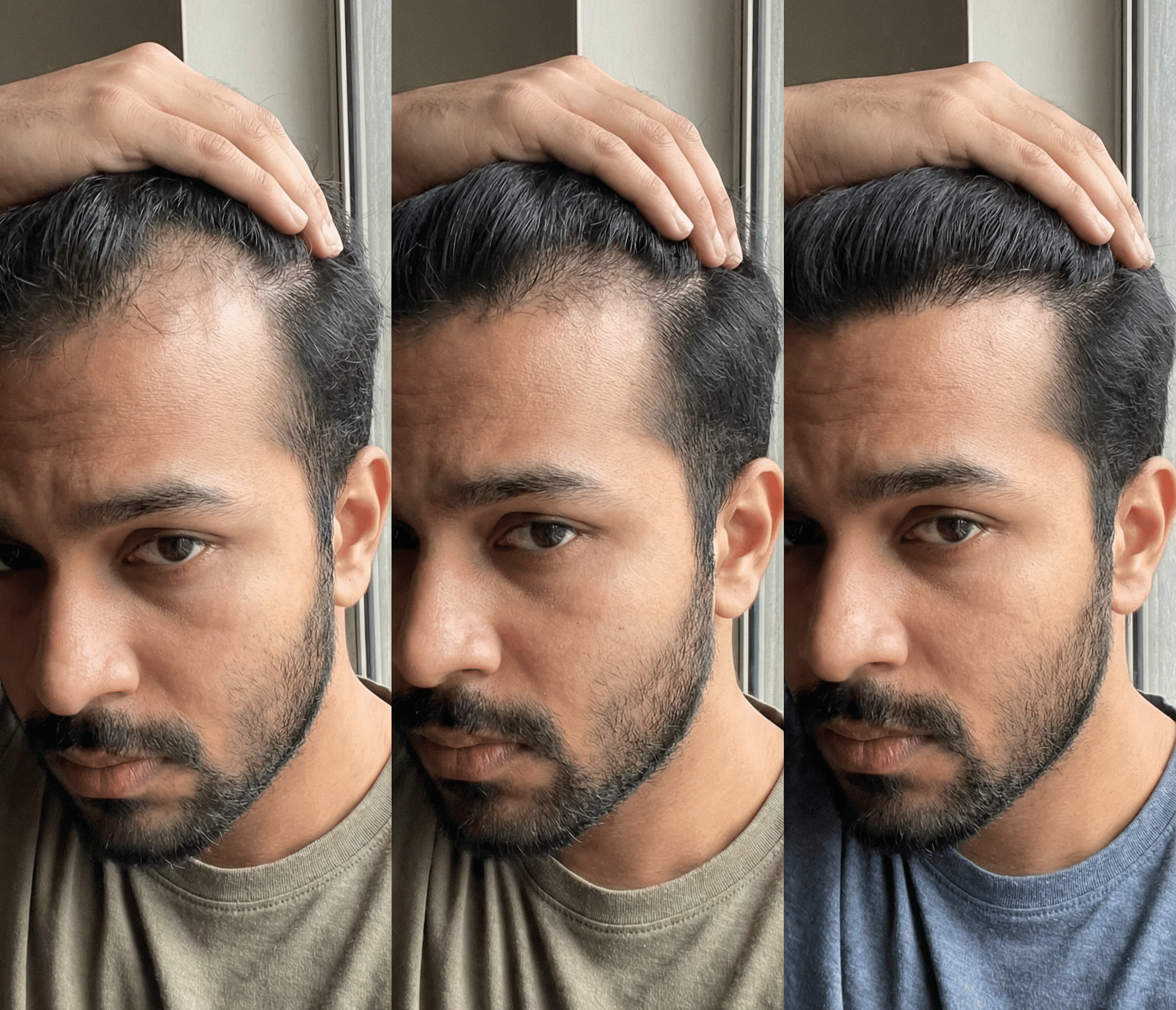 Hairline regrowth progression across three stages of treatment