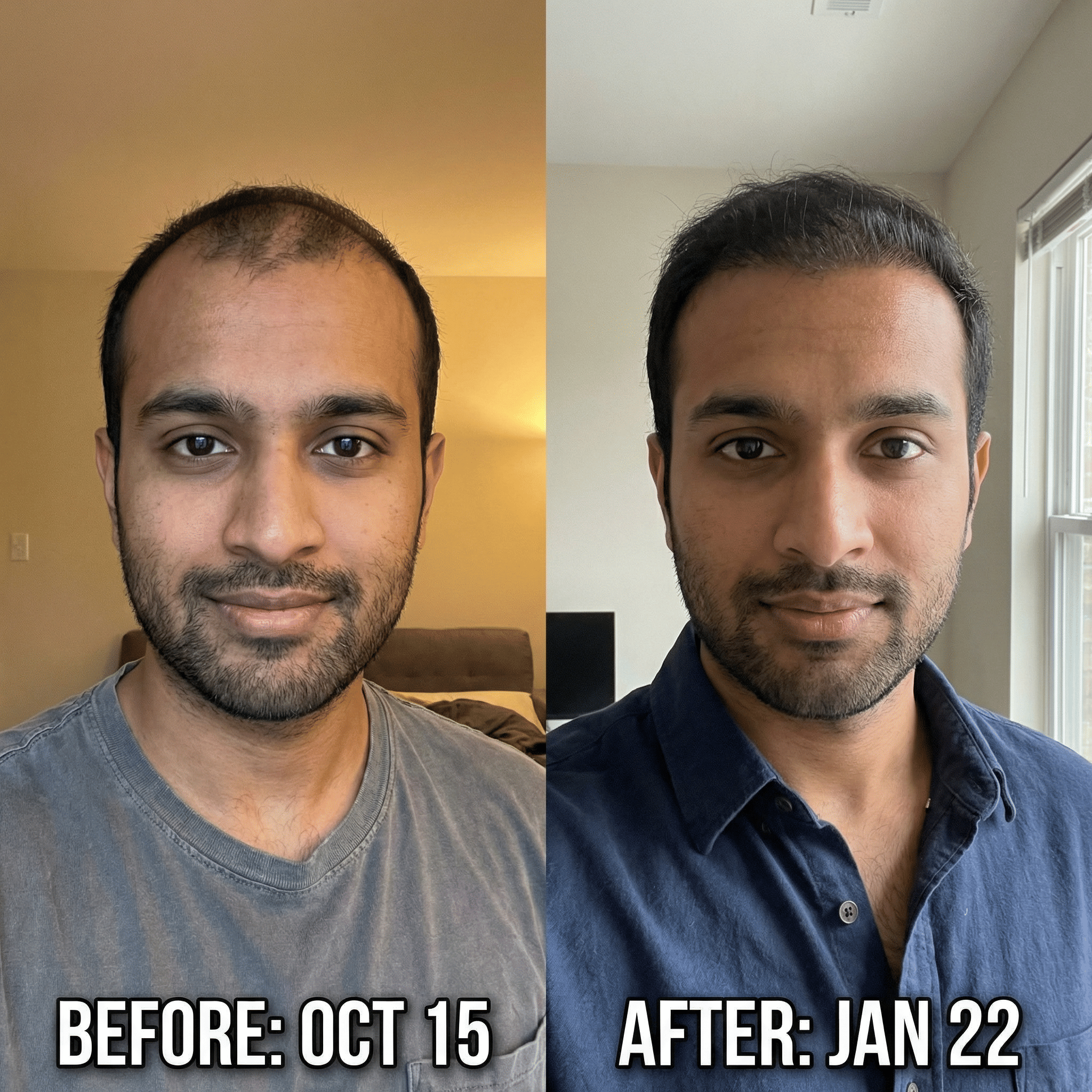 Hair count comparison before and after months of treatment after using minoxidil 5%