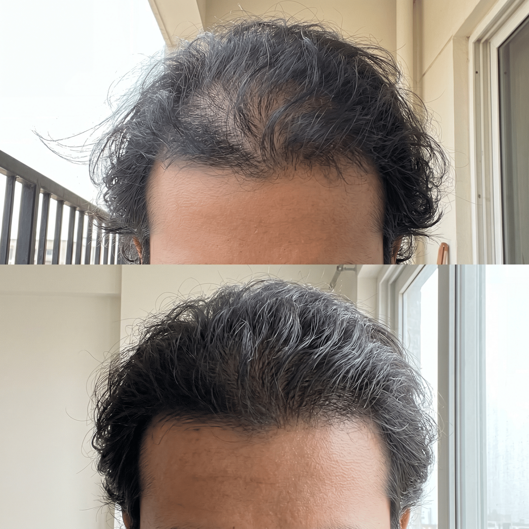 Hairline and temple regrowth comparison before and after finasteride use