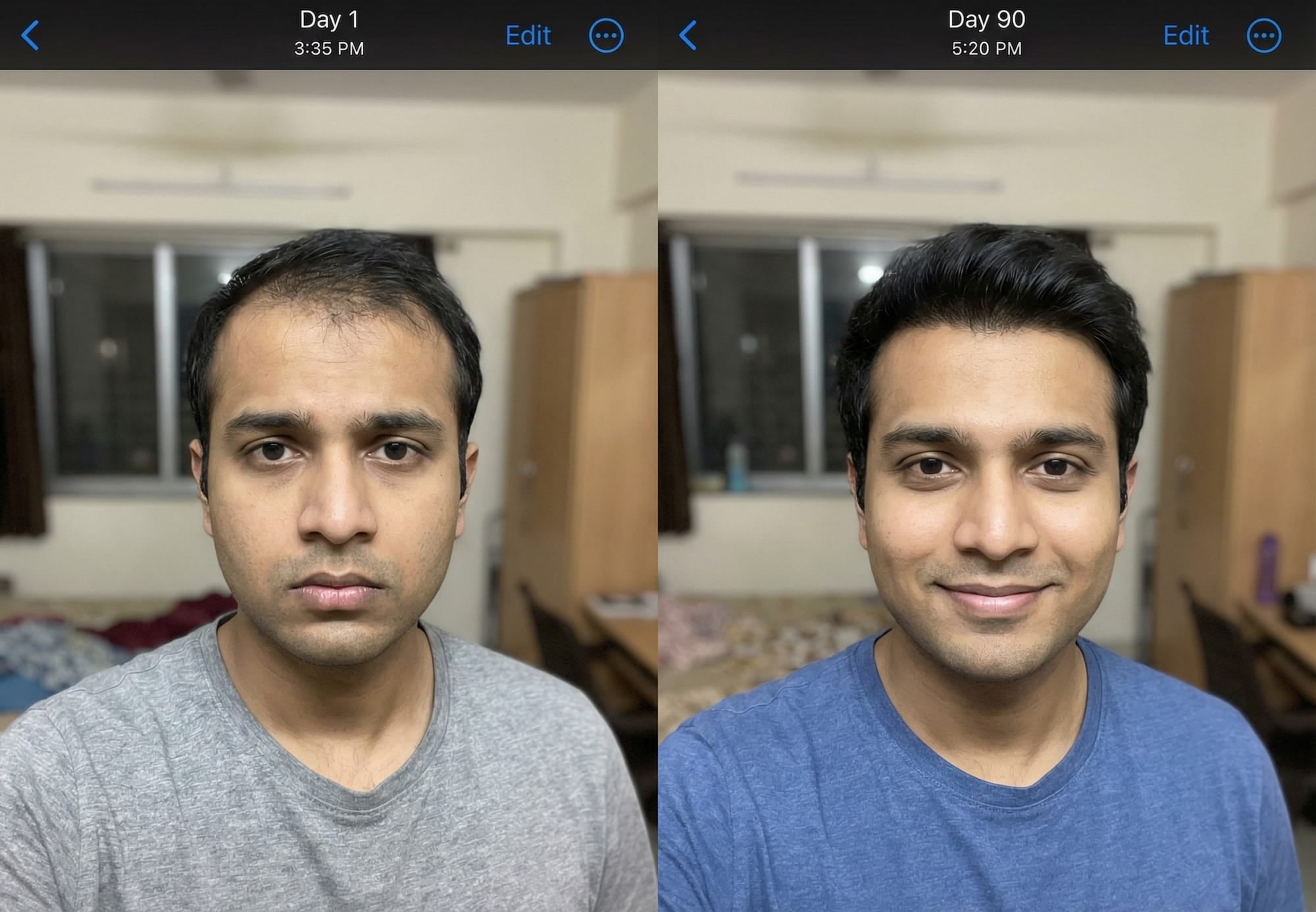 Minoxidil progress tracking photo comparison Day 1 versus Day 90 same angle and lighting