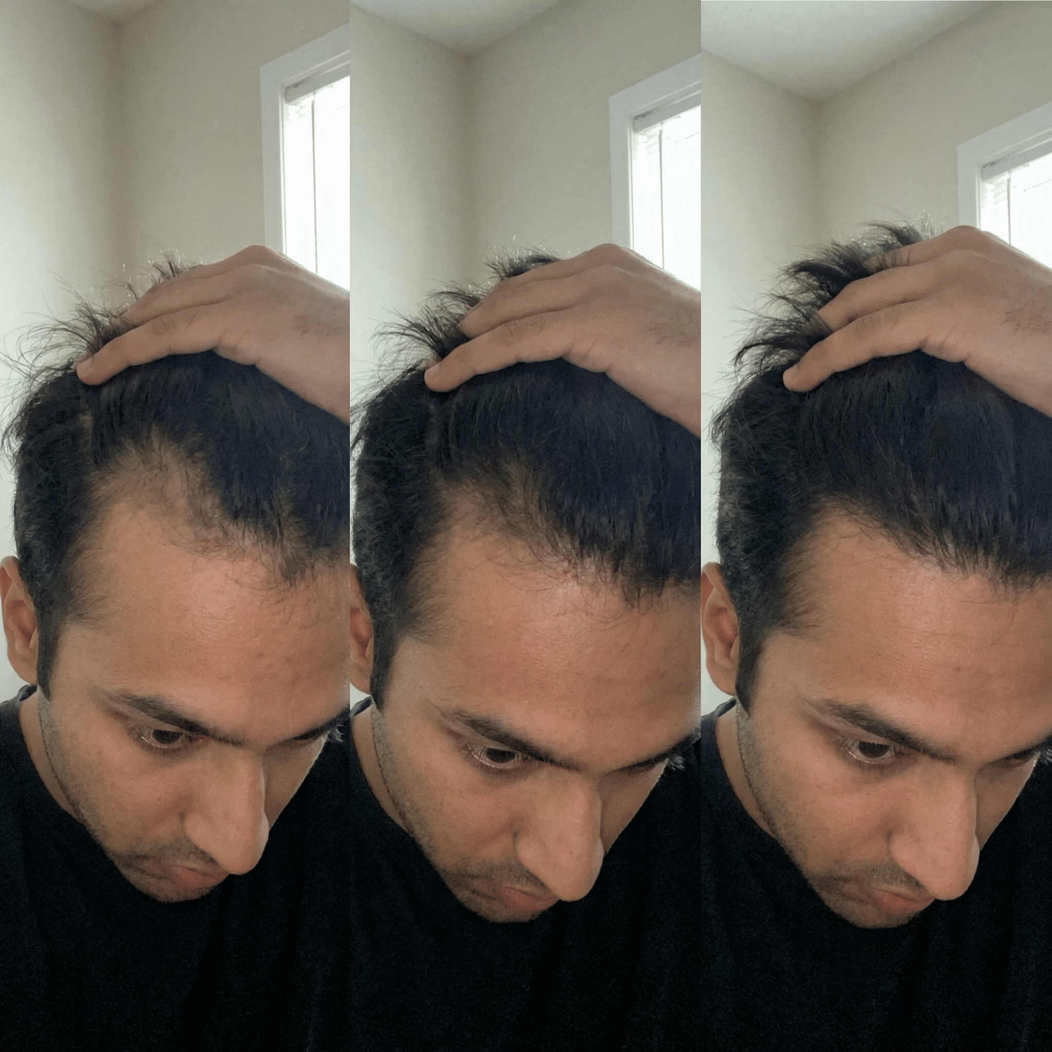Man parting his hair to check hairline and scalp for signs of hair fall
