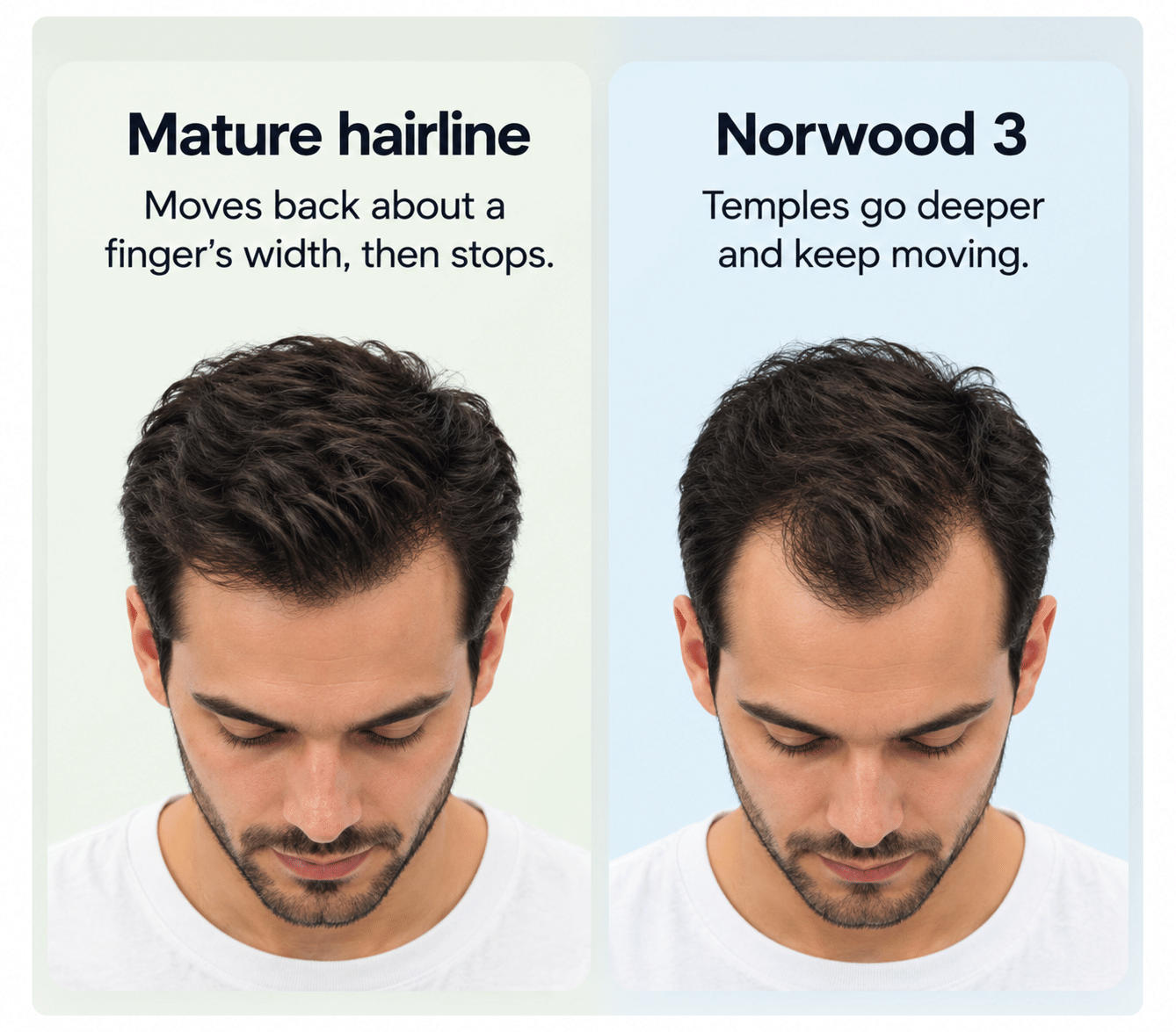 Comparison of a mature hairline and a Norwood 3 hairline