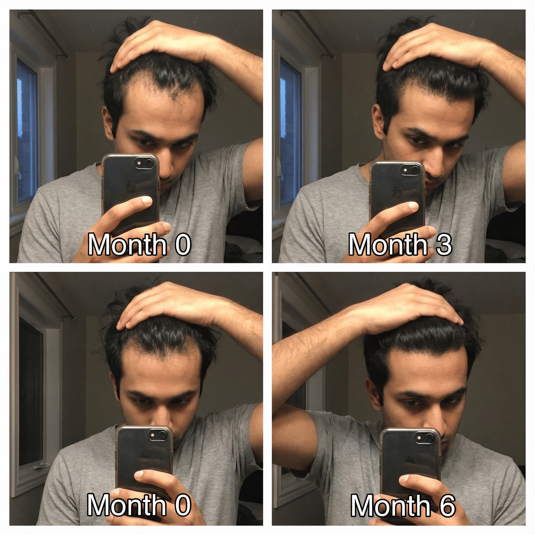 Tracking hairline at Month 0, Month 3, and Month 6 using the same angle and lighting