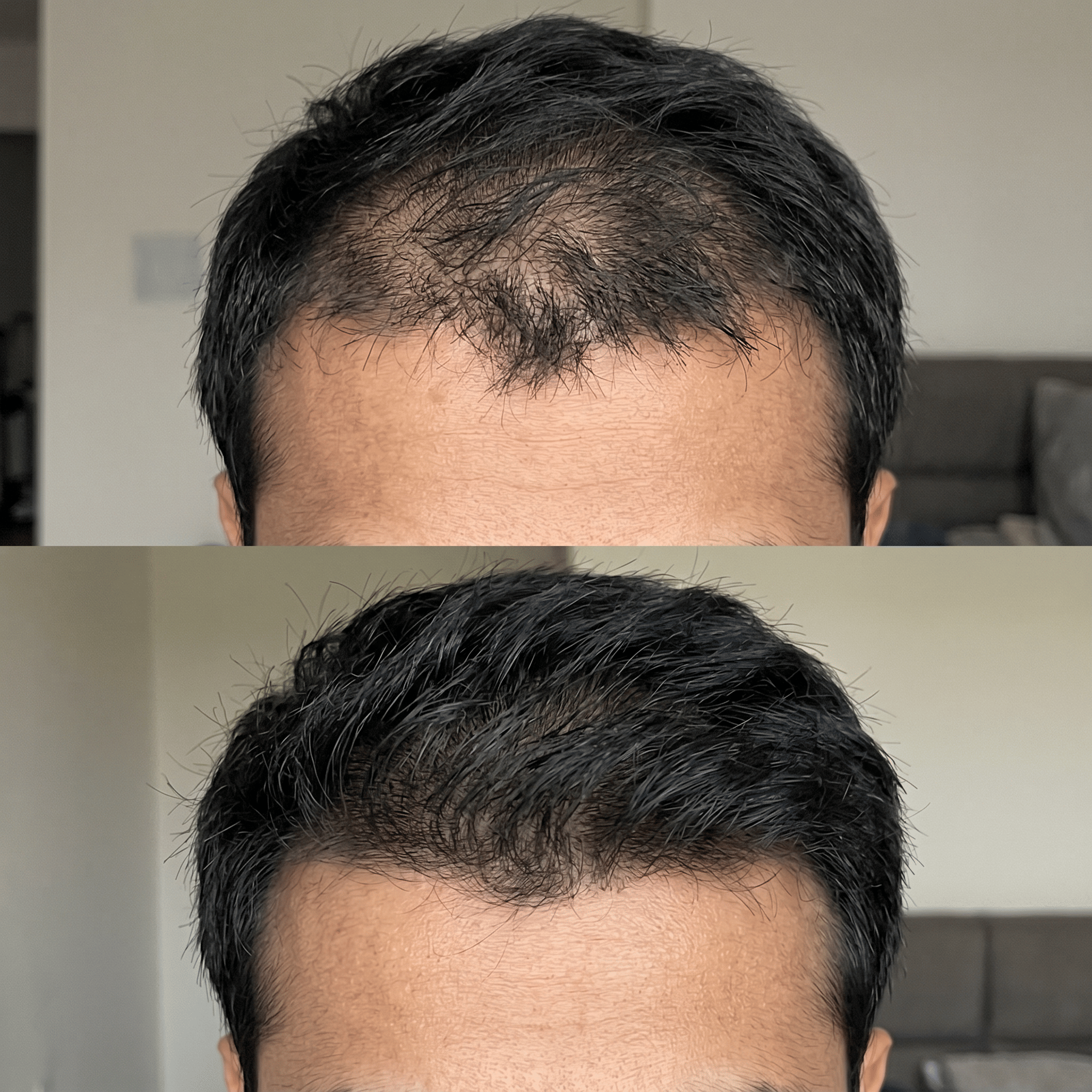 Close-up of crown and scalp area where topical minoxidil is applied